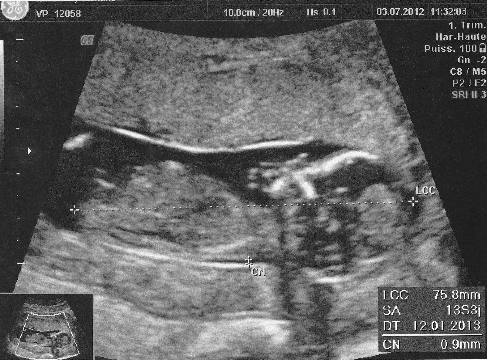 Naissance de Melchior et MOULAGE TENDRE